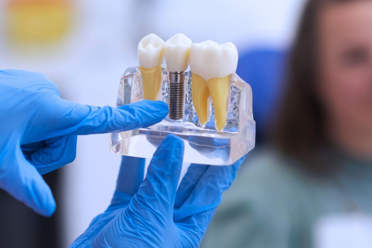 dental-implants