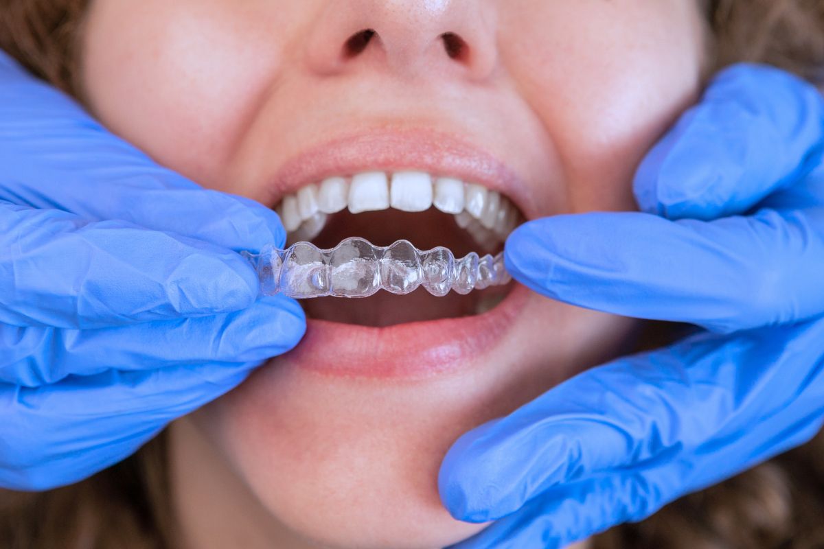 invisible-braces