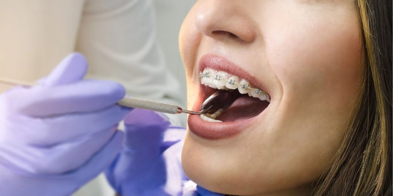 Braces-Treatment