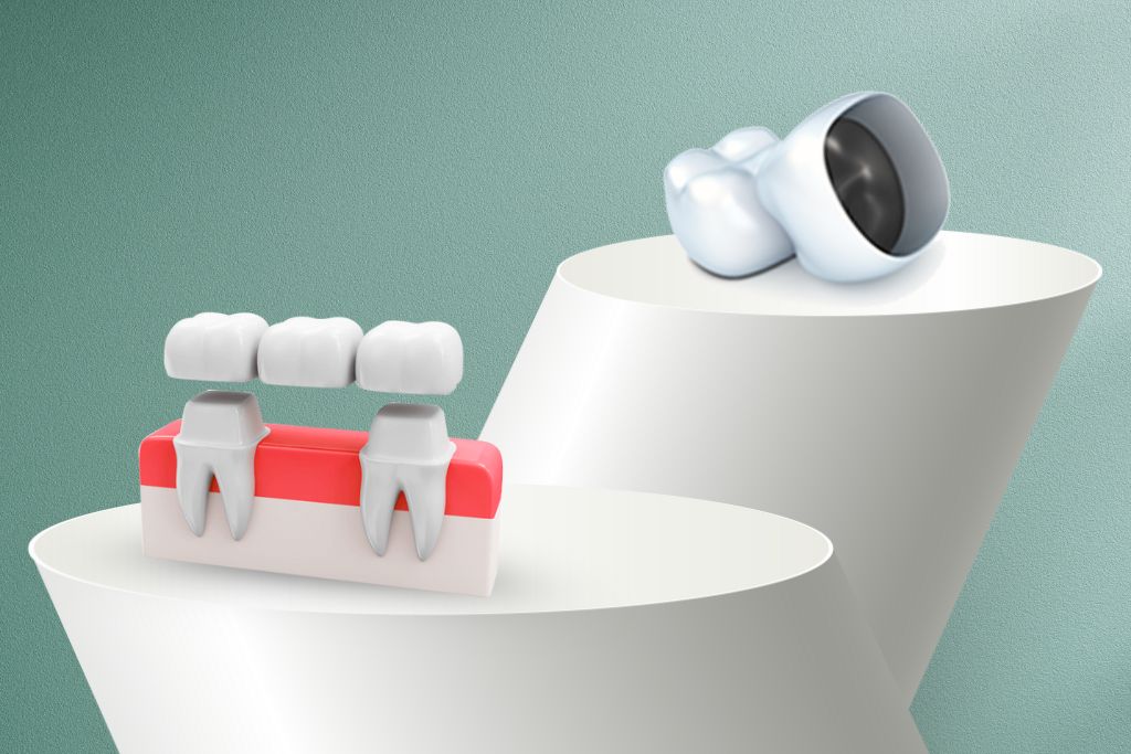 Dental-Crown-Bridge-Treatment
