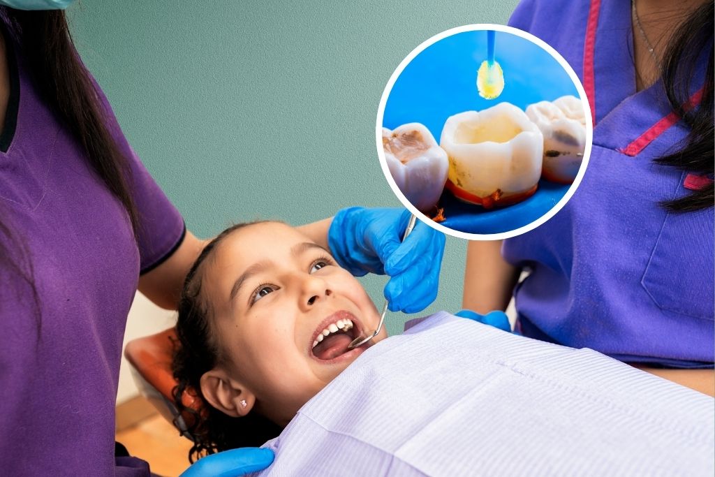 Tooth Cavity Filling