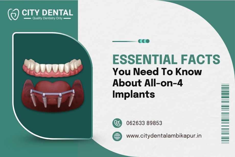 essential facts you need to know about allon4 implants