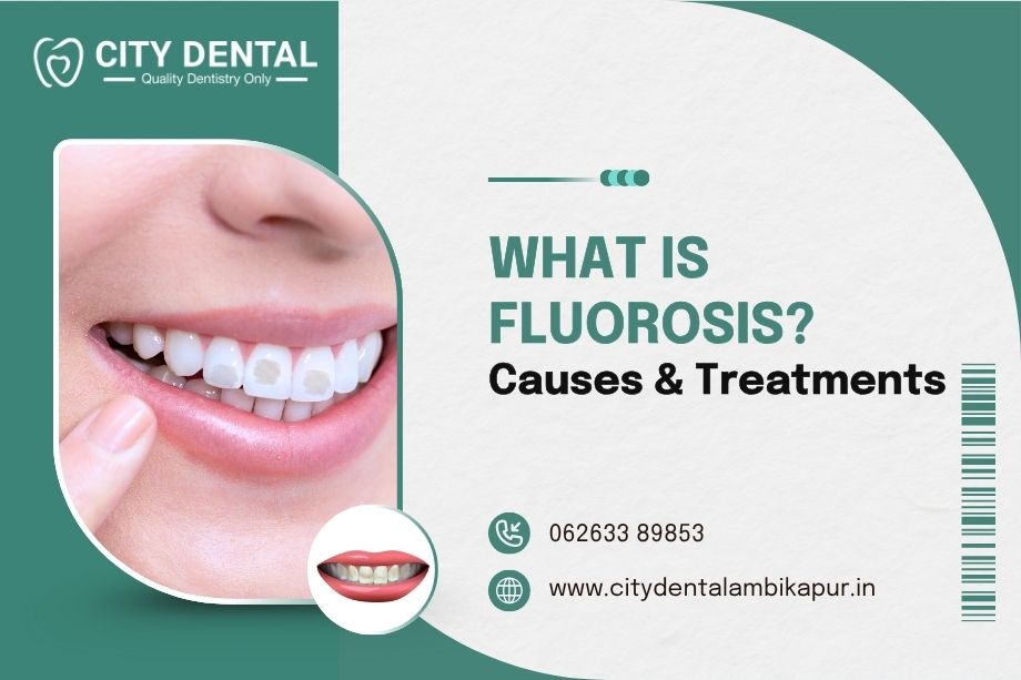 what-is-fluorosis-causes-treatments
